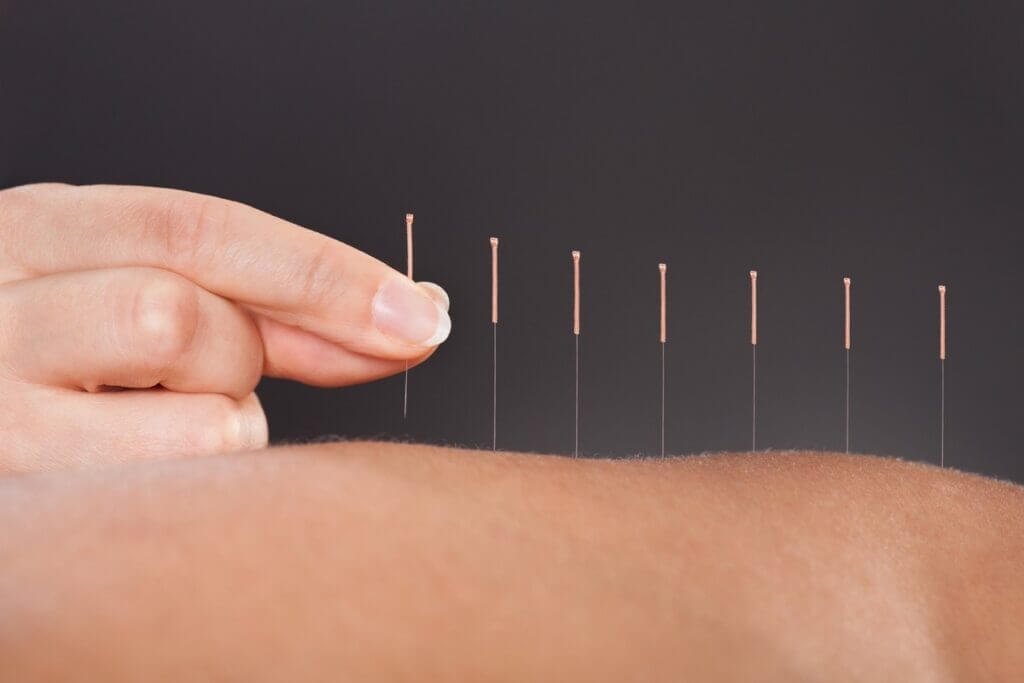 Perdre du poids grâce à l’acupuncture