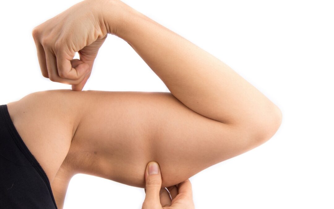 Cryolipolyse des bras : tout savoir