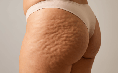 Peau d’orange, bourrelets localisés, perte de fermeté : comment la cryolipolyse peut-elle vraiment aider ?